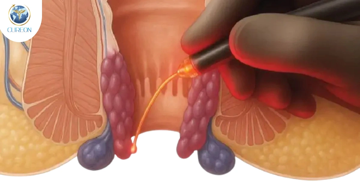 Laser Piles Surgery in India : How is it different from Traditional Methods-extra-1