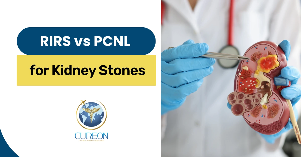 RIRS vs PCNL for Kidney Stones: Which Procedure Is Used for Which Stone?