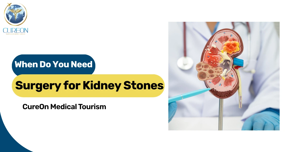  When Do You Need Surgery for Kidney Stones?