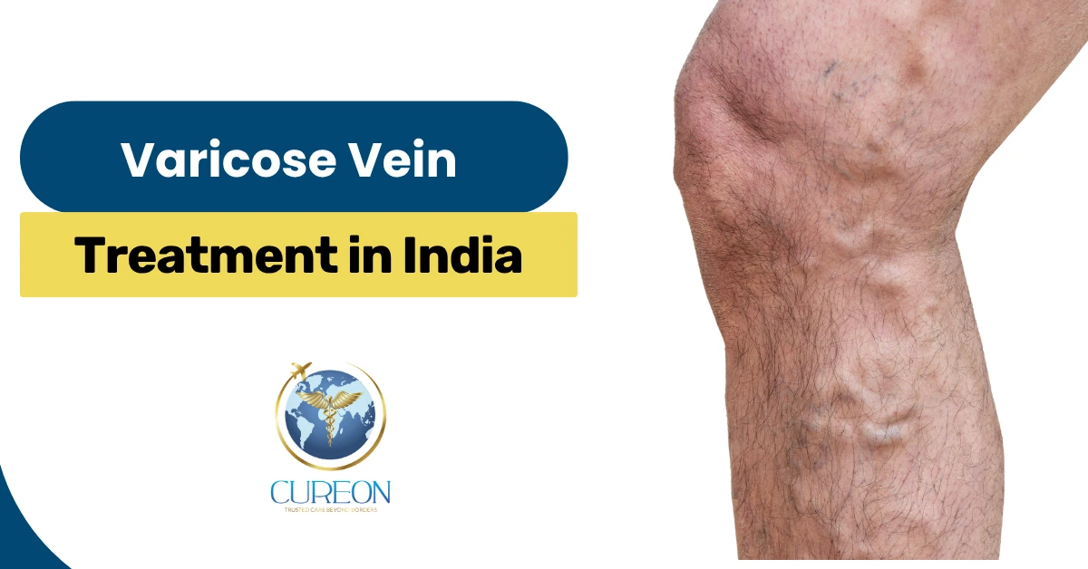 Varicose Vein Treatment in India: Laser, RFA or Glue  Which Is Suitable?