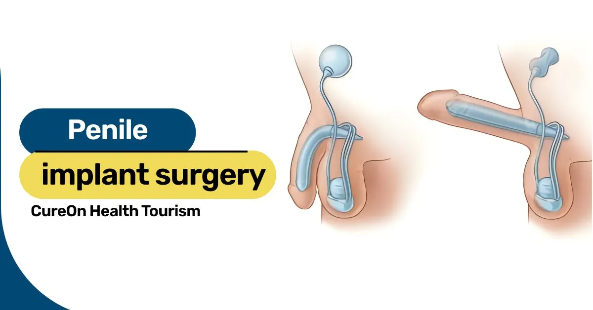 Penile Implant Surgery in India: Cost, Procedure & Recovery