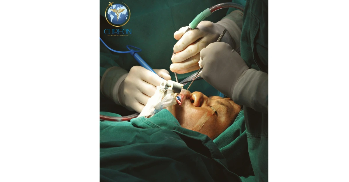 Sleep Apnea Surgery: When Is Treatment Needed Beyond CPAP?-extra-1