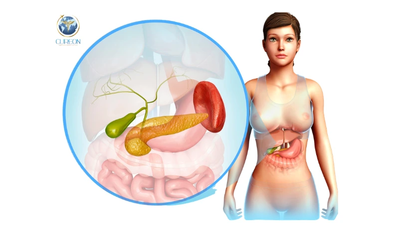 Best Gallbladder Stone Treatment in Indore with CureOn Medical Tourism-extra-1