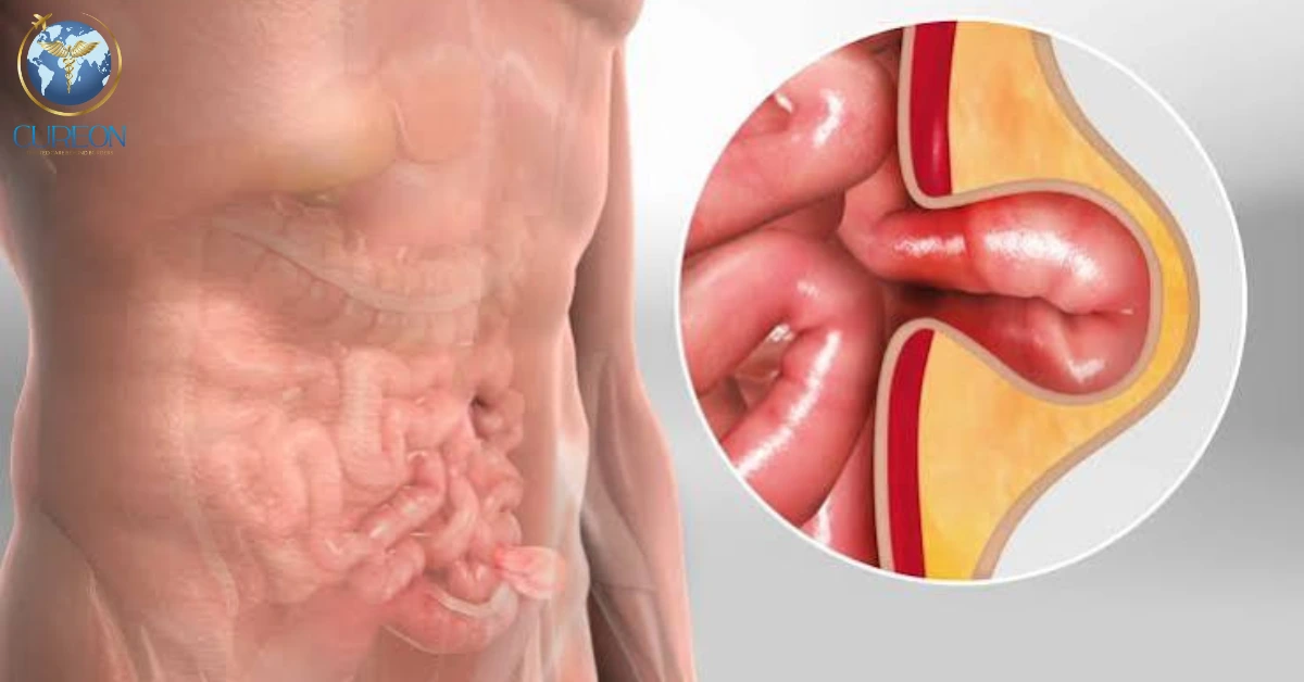 Hernia Treatment in Indore-extra-1
