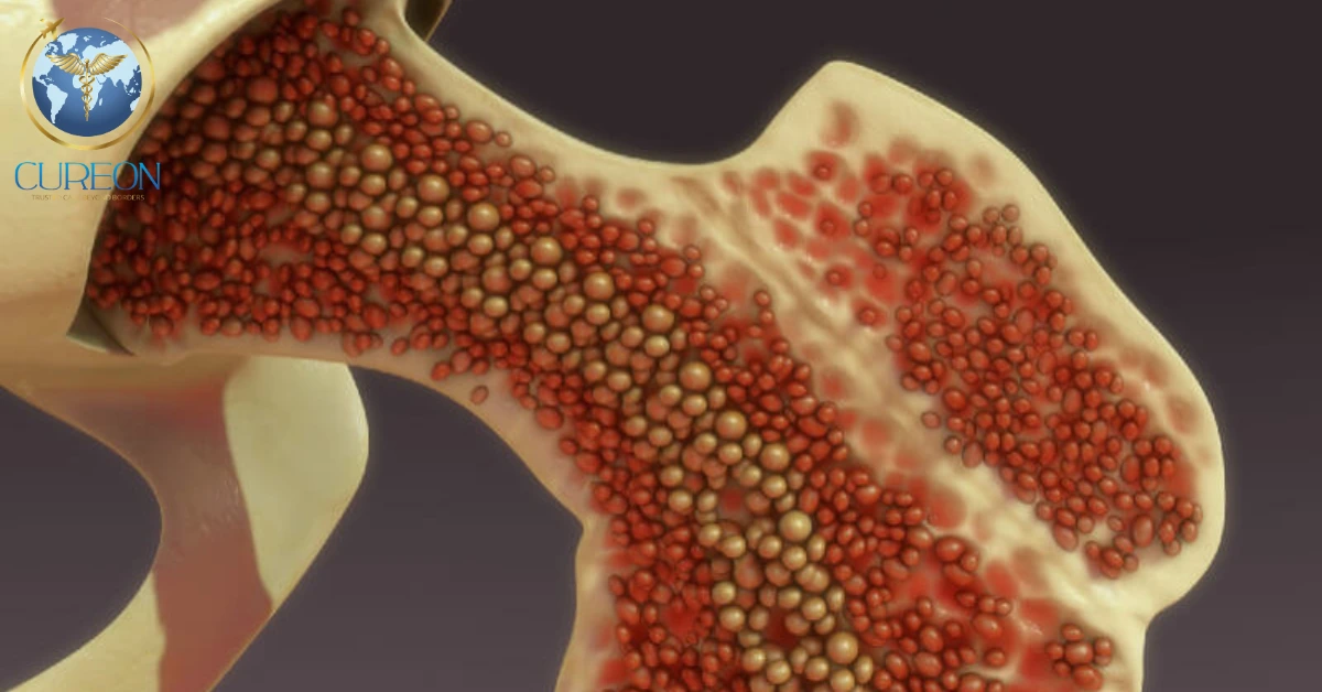 Bone Marrow Transplant in India: Cost, Types, Hospital Stay & Recovery -extra-1