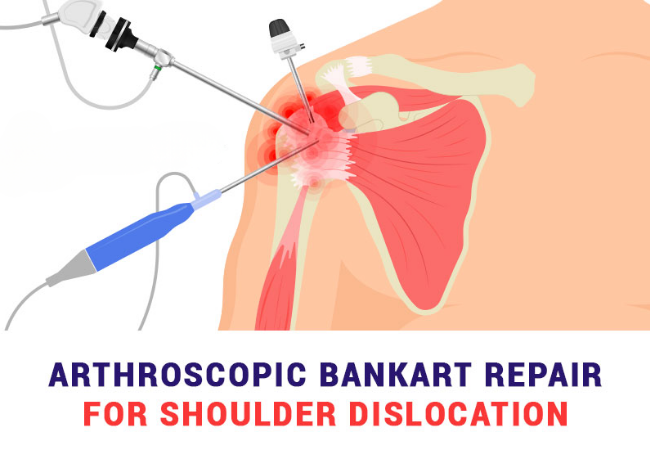 Shoulder - Arthroscopic Bankarts Repair