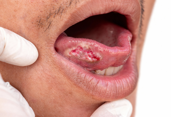 Small Tongue Cancer with Neck Dissection