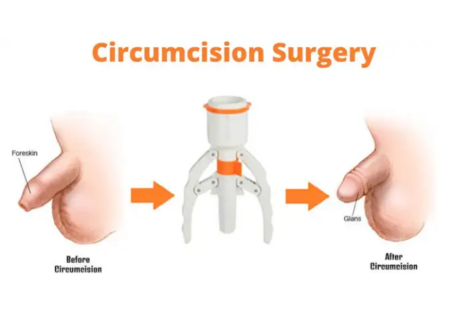 ZSR(Zeta Sedimentation Ratio) Circumcision