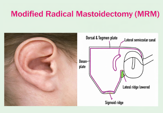 Modified Radical Mastoidectomy