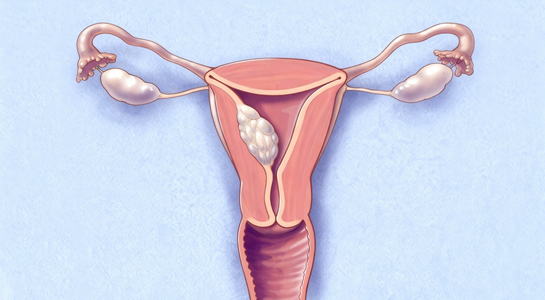 Endometrial Cancer Surgery