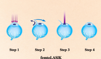 Bladeless Femto LASIK