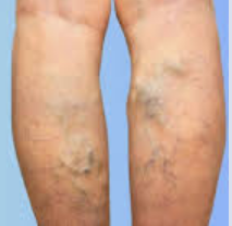 Varicose Glue two side