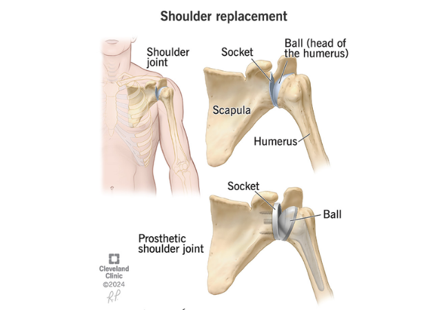 Shoulder Replacement