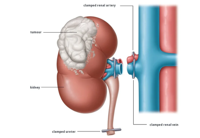 Nephrectomy Open