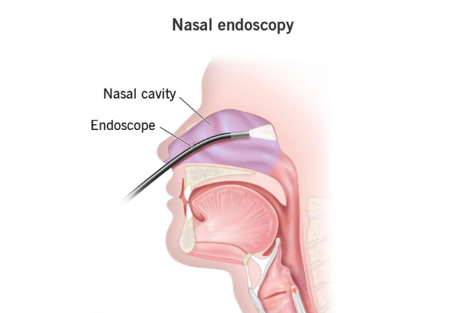Diagnostic Nasal Endoscopy (DNE)
