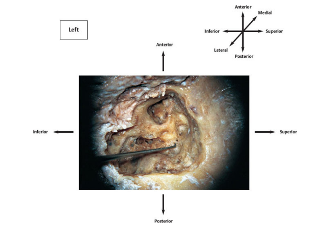 Extended Modified Radical Mastoidectomy