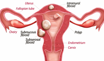 Uterine Cancer Surgery