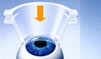 LASIK With Blade