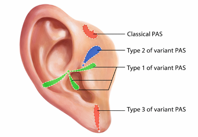 Pre Auric sinus