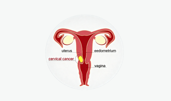 Cervical Cancer Surgery