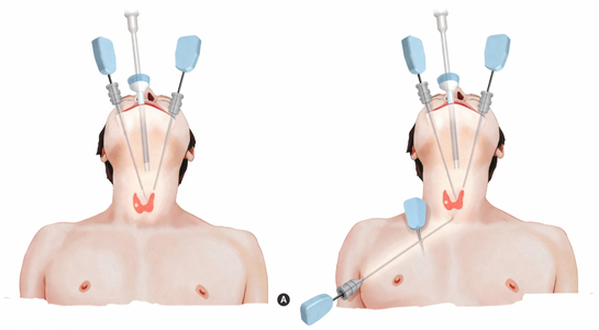 Thyroid Surgery