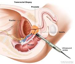 Prostate Biopsy