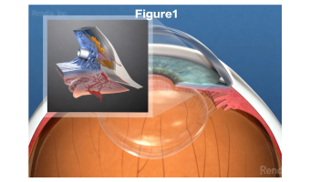 Minimally Invasive Glaucoma Surgery (MIGS)