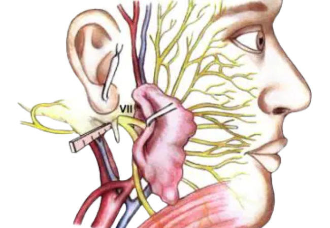 Total parotidectomy