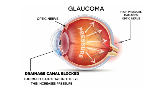 Glaucoma surgery