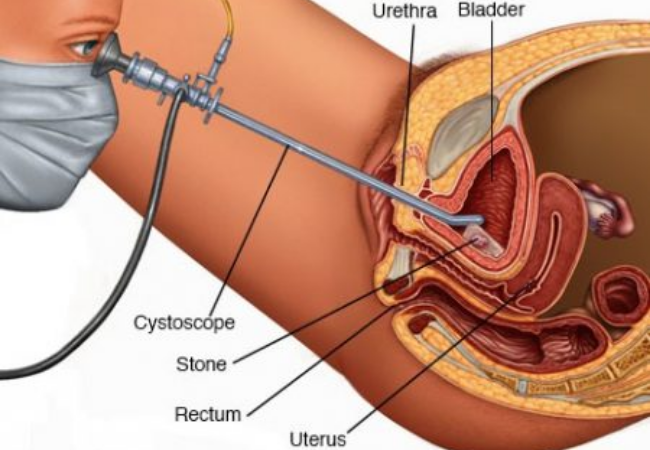 Cystoscopy & Double-J Stenting