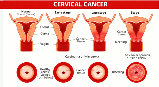 Cervical Cancer Surgery