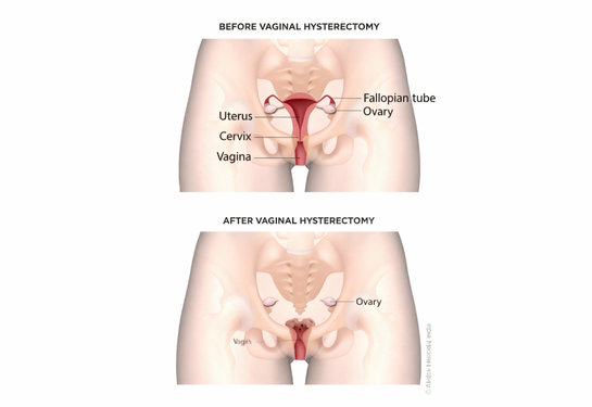 Vaginoplasty