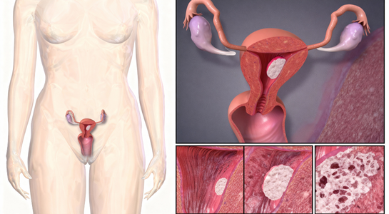 CA Endometrium