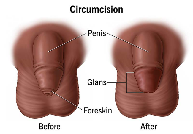 Circumcision