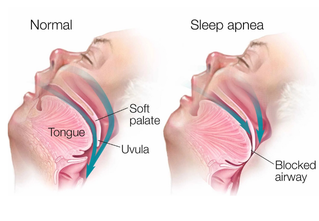 Obstructive Sleep Apnea