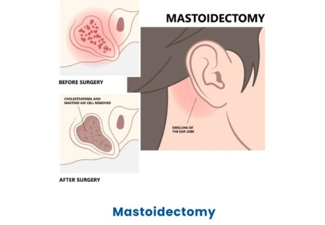 Modified Radical Mastoidectomy under General Anesthesia (GA)
