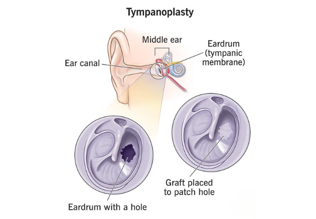 Tympanoplasty with Cortical Mastoidectomy under general anesthesia
