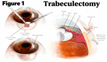 Glaucoma surgery