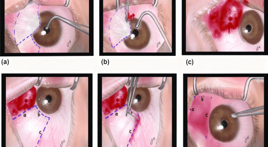 Pterygium Surgery With Sutures