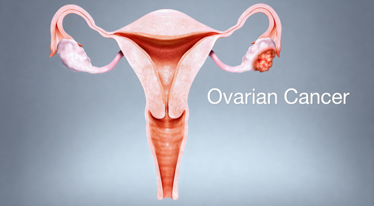 Ovarian Cancer Surgery