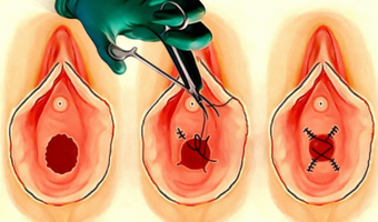 Hymenoplasty