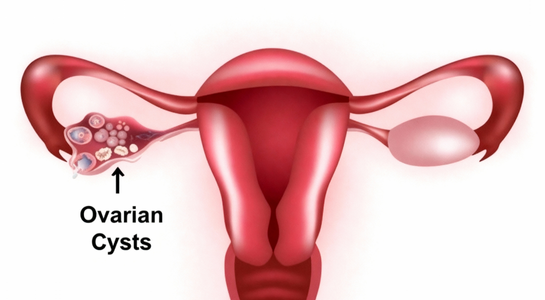 Ovarian Cyst
