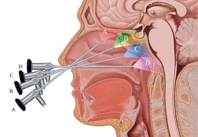 Endoscopic Skull Base