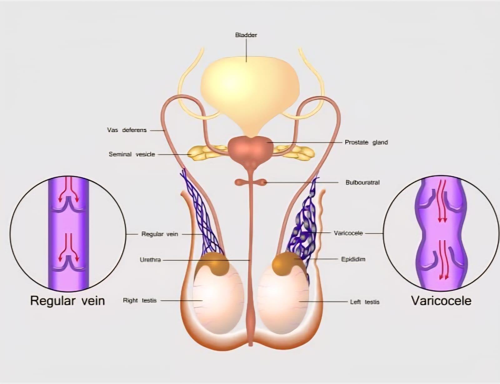 Varicocele Embolisation Both Side