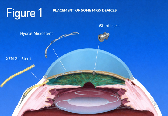 Minimally Invasive Glaucoma Surgery (MIGS) 