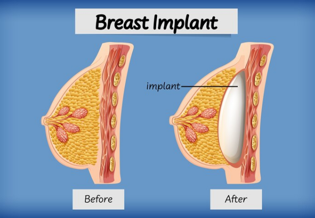 Breast Implant