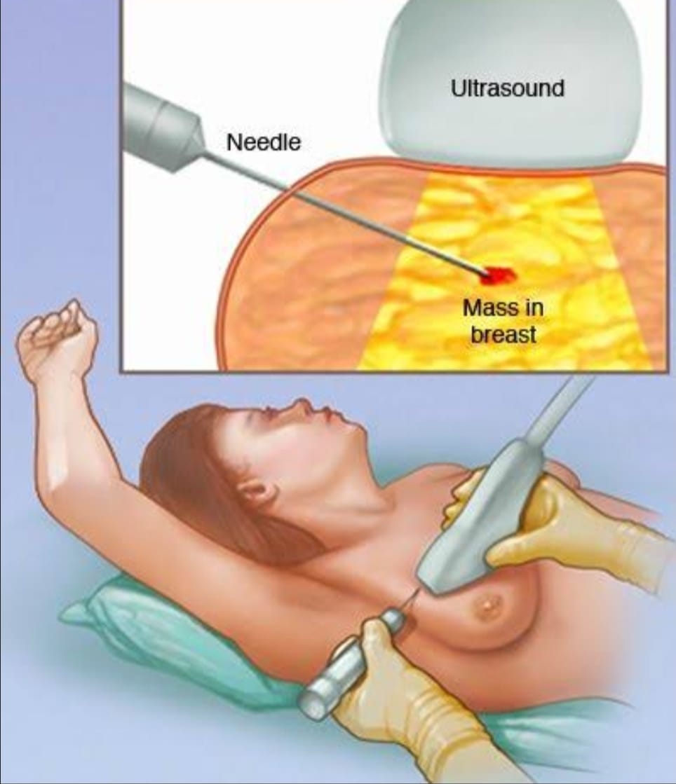 USG Guided Biopsy