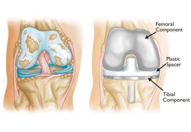 Total Knee Replacement