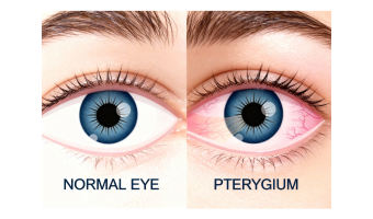 Pterygium Surgery Sutureless