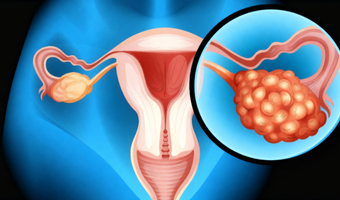 Ovarian Cancer Surgery